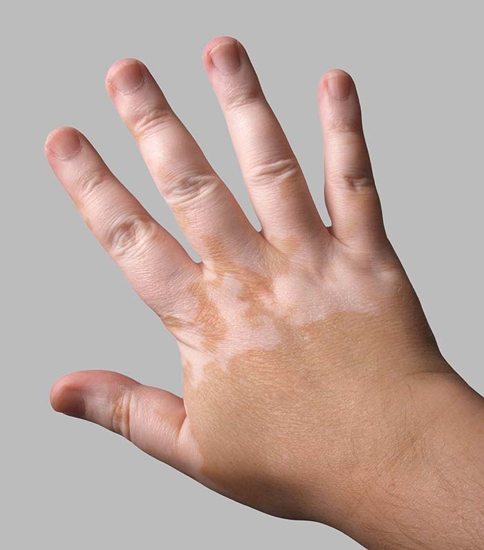 Vitiligo